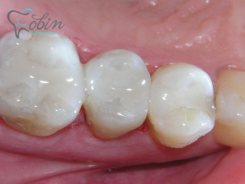 تشخیص استفاده از کامپوزیت در دندان